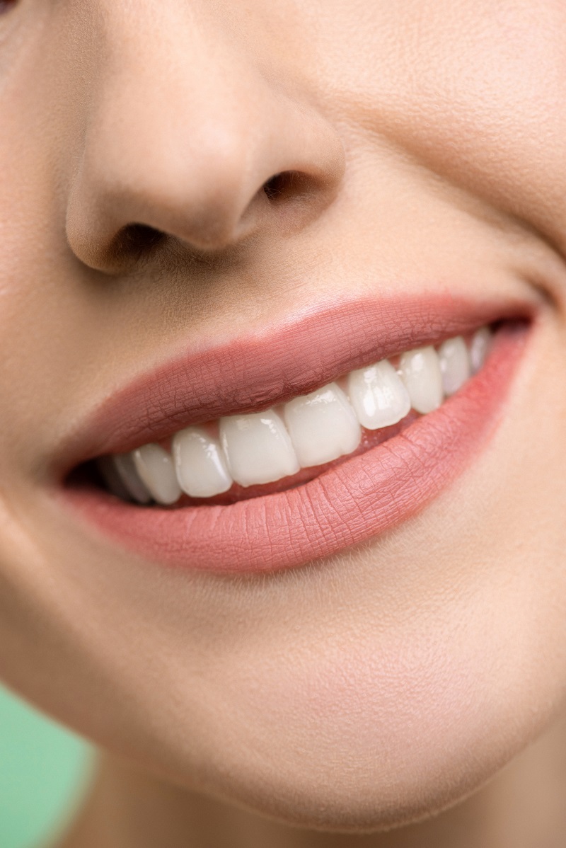 Dental Veneers for the Most Beautiful Smile Lifetime Dental Excellence